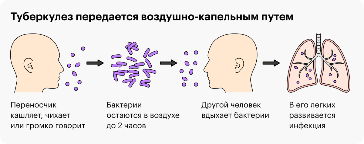 Радикулит – Причины, симптомы и лечение