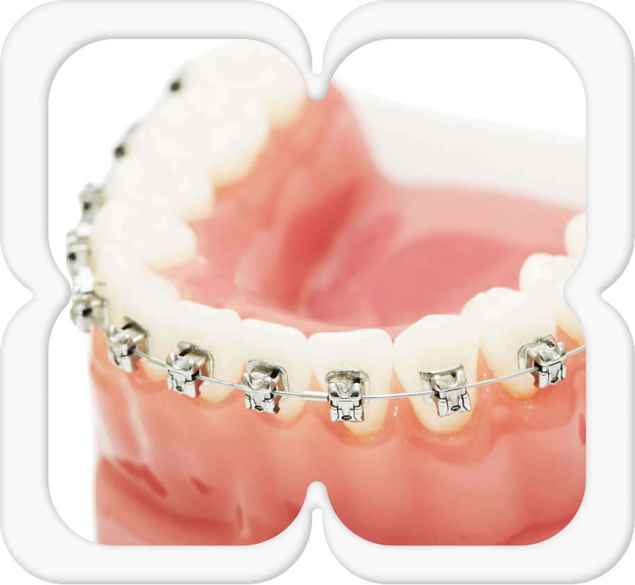 «Зубы снова разъехались»: 9 проблем, с которыми можно столкнуться, если поставить брекеты