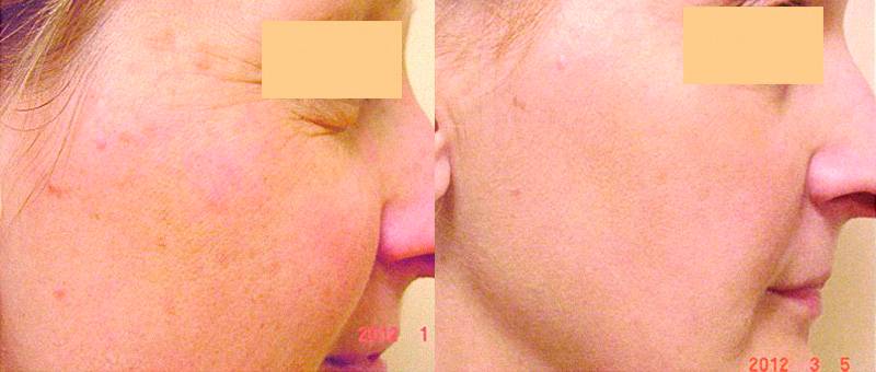 Фото 45-летней женщины до и после лечения кожи аппаратом&nbsp;IPL с длиной волны&nbsp;550