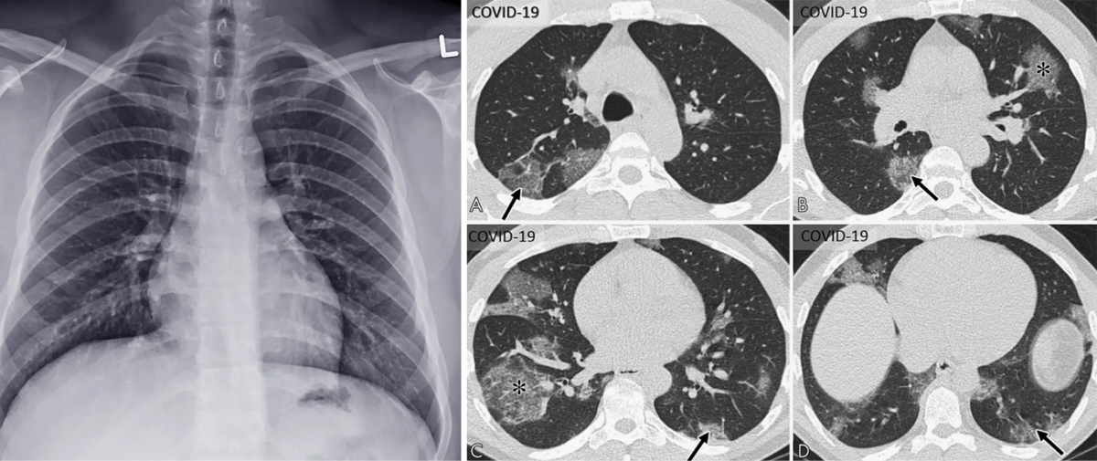 Слева — рентгенограмма грудной клетки, похожая на обычную фотографию. Справа — КТ-изображение грудной клетки, нарезанное на отдельные «ломтики», чтобы врачу было удобнее их изучать