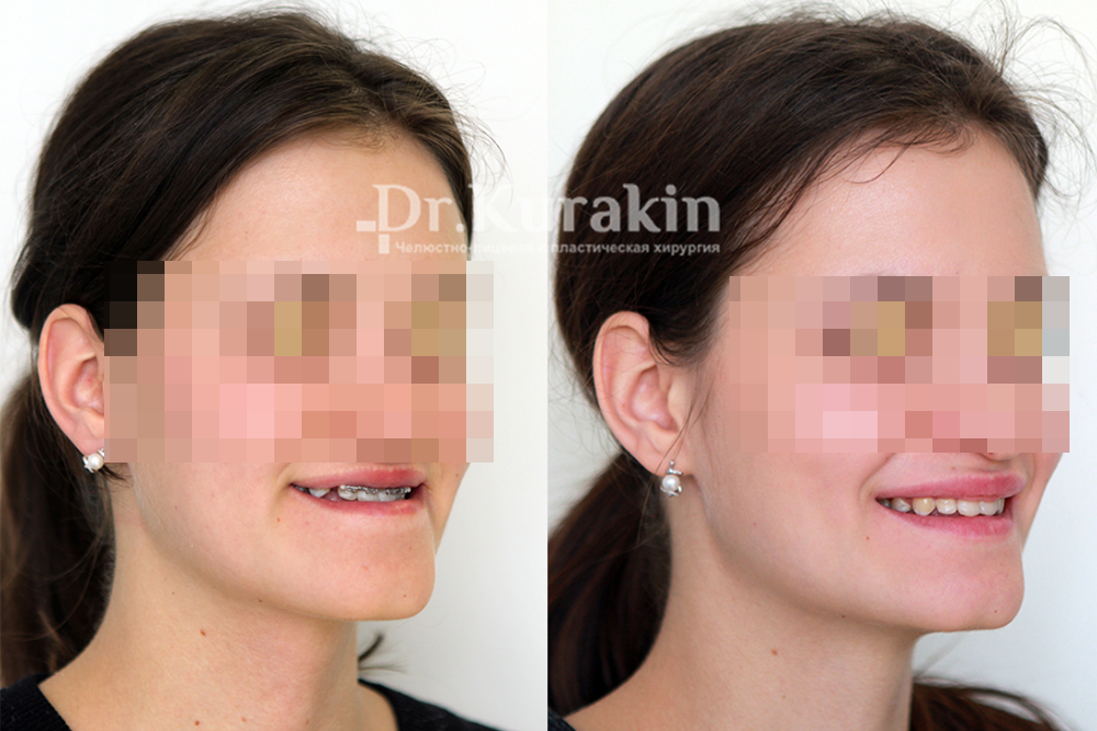 Фото перед операцией и спустя 14&nbsp;месяцев. Источник: Dr.&nbsp;Kurakin