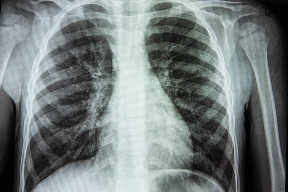 Рентгеновское изображение грудной клетки. Источник: Bal Iryna / Shutterstock