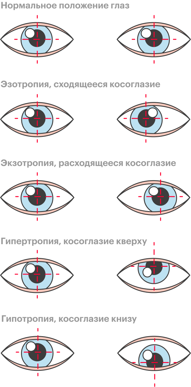 Косоглазие У Детей Фото