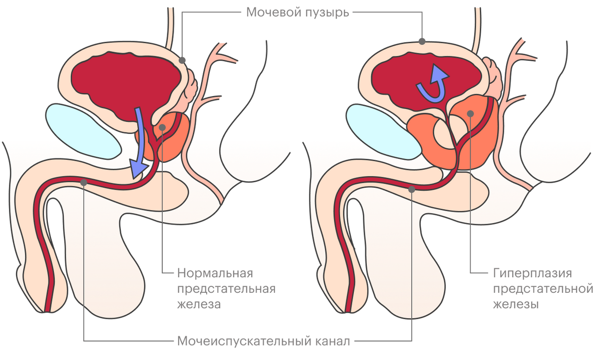 При&nbsp;аденоме предстательной железы она увеличивается и может пережать мочеиспускательный канал
