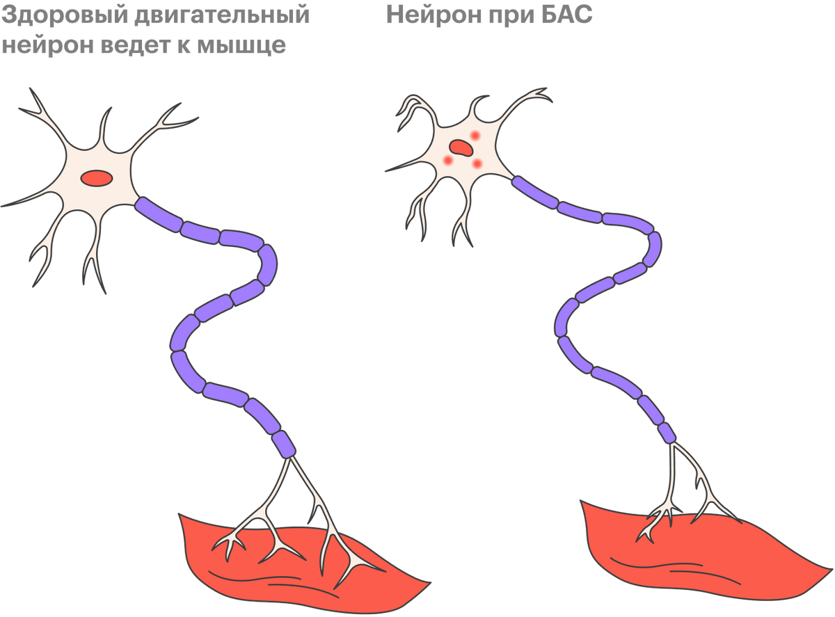 БАС поражает два типа нервных клеток: верхние и нижние мотонейроны, которые своими импульсами приводят мышцы в движение. Сначала нейроны ослабевают, затем начинают подергиваться, а после истощаются и отмирают. Именно поэтому на начальных стадиях болезни человеку может быть сложно застегнуть пуговицу, написать что-то или открыть дверь ключом. Потом на разных участках его тела подергиваются мышцы. А затем человек перестает говорить, есть, ходить и дышать