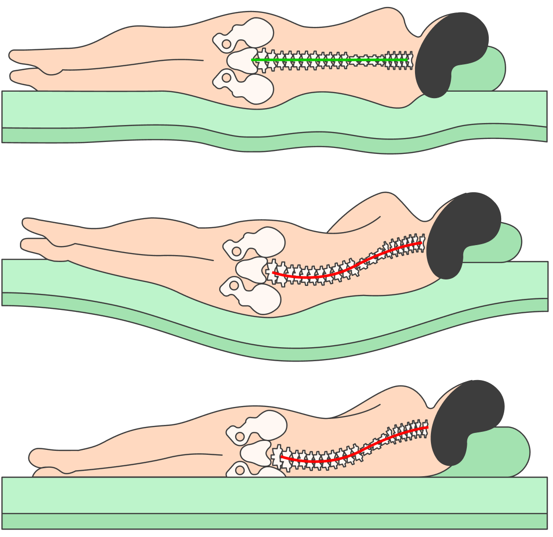 Какой матрас лучше при грыже позвоночника. Позвоночник лежа на боку. Правильный матрас для позвоночника. Позвоночник в положении лежа на боку. Позвоночник на матрасе.