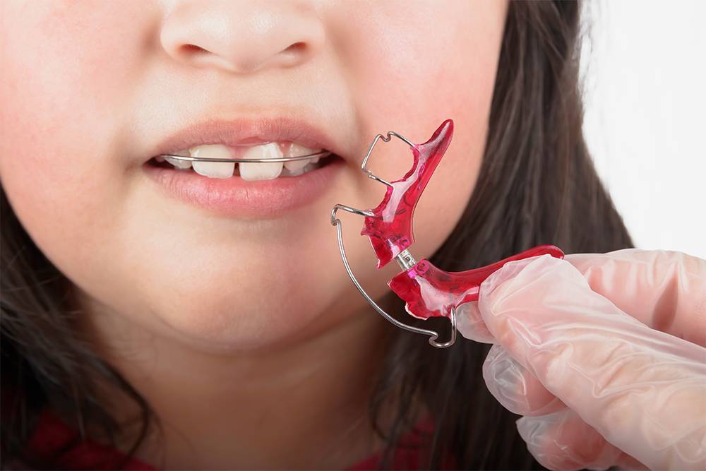 Съемная ортодонтическая пластинка. Источник: GraphicPhotoArt -MomPhoto / Shutterstock