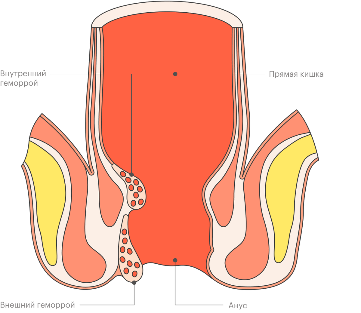 Как Выглядит Геморрой Фото