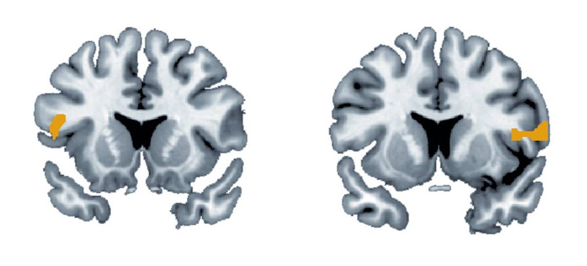 Слева — мозг человека, который узнал: его вероятность заболеть раком ниже, чем он предполагал. Справа — мозг другого человека, чей риск заболеть раком оказался выше, чем он думал. В первом случае активна левая нижняя лобная извилина, во втором — правая нижняя лобная извилина. Источник: ScienceDirect