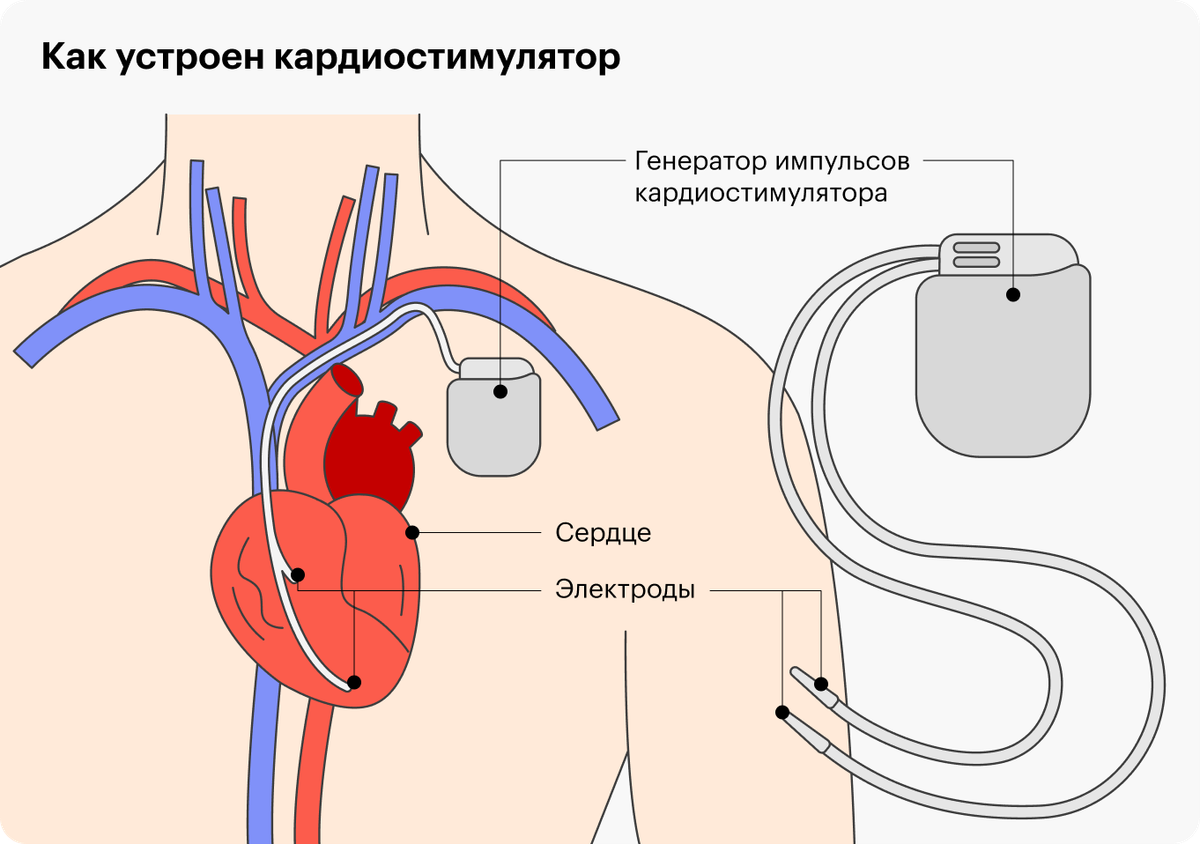 Кардиостимулятор сердца что это такое фото