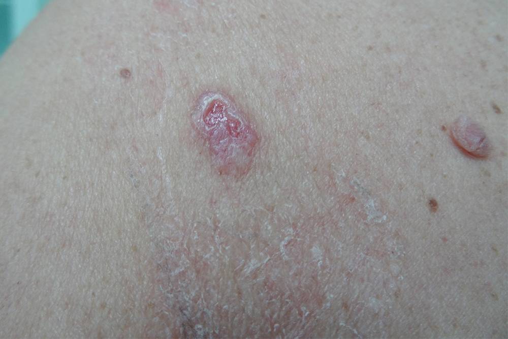 Так выглядит немеланомный рак кожи — базалиома