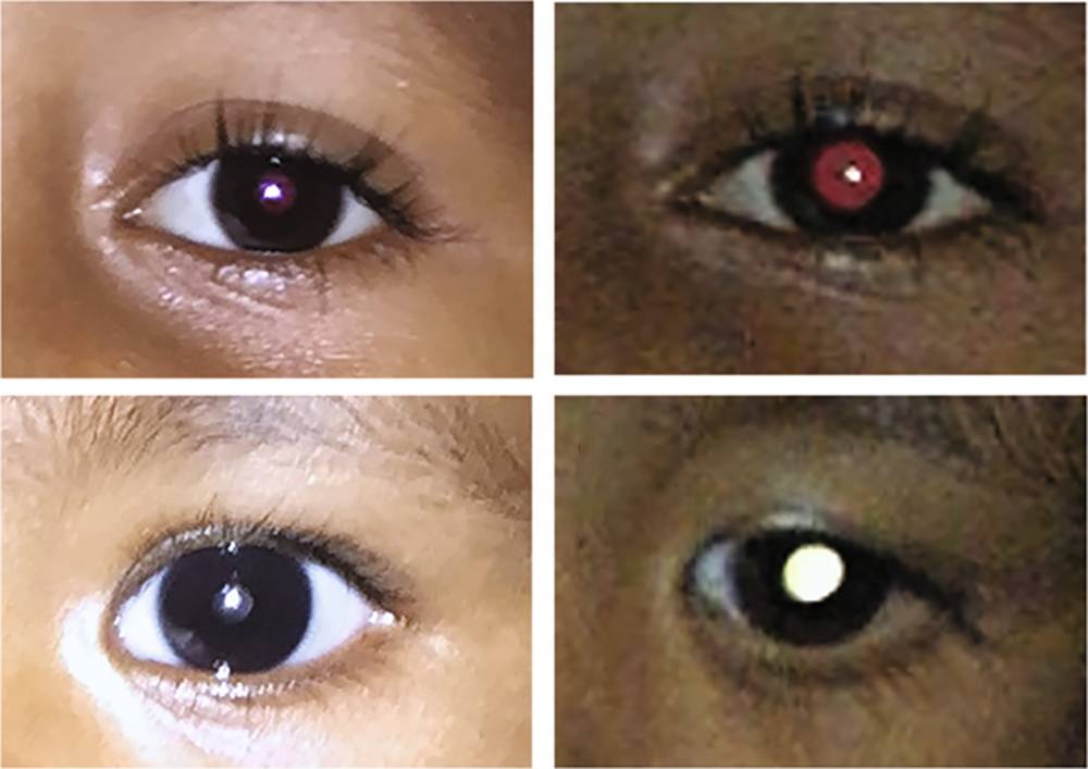 Верхний ряд фотографий — нормальный глаз, при&nbsp;фотосъемке отблеск будет красным. Нижний ряд — глаз с ретинобластомой, отблеск зеленоватый, без&nbsp;красного оттенка. Источник: Nature