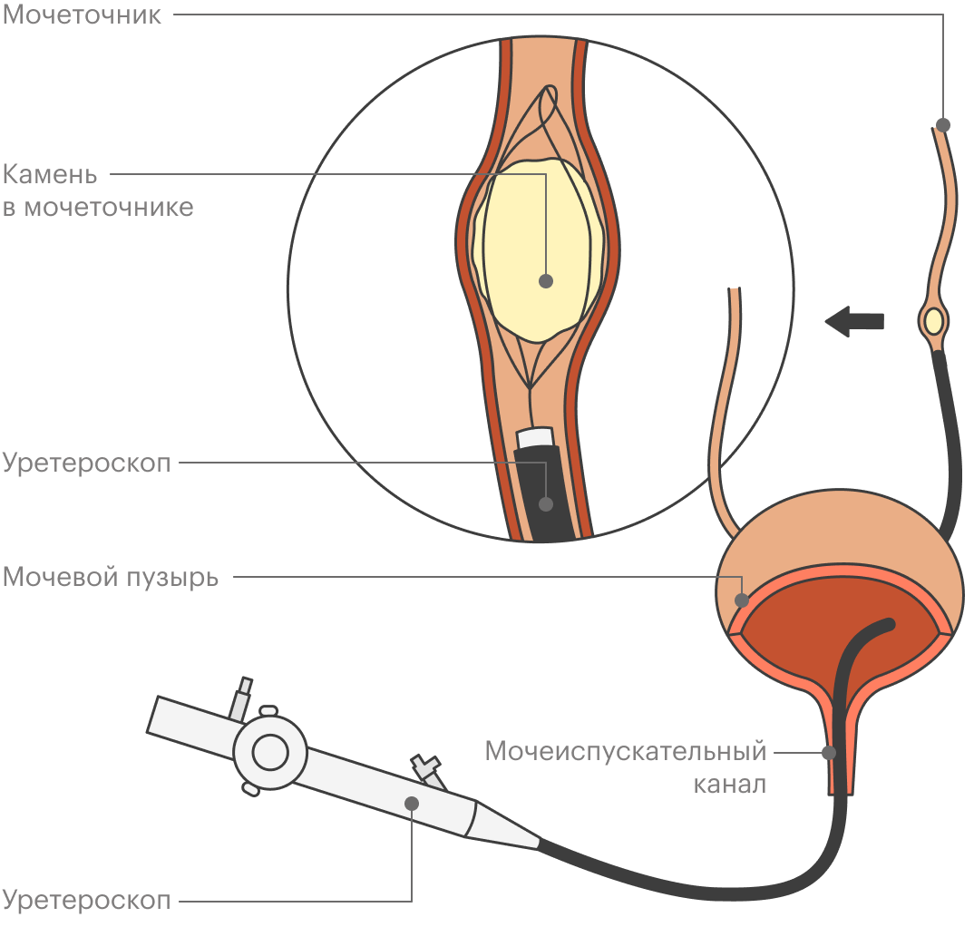 Как дробят камни в мочеточнике у мужчин. Камень в мочеточнике у женщин. Мочеиспускательный канал у женщин схема.
