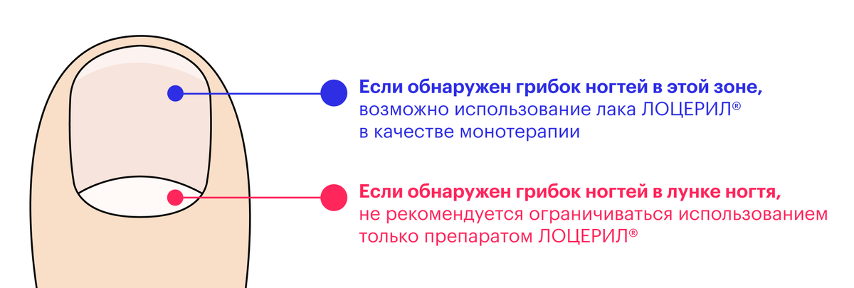 Грибок Ногтей Стадии Фото