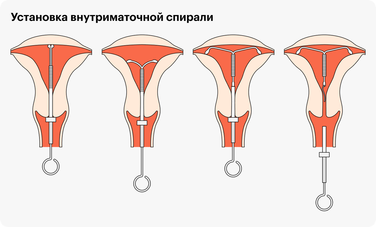 спираль можно ли кончить фото 9