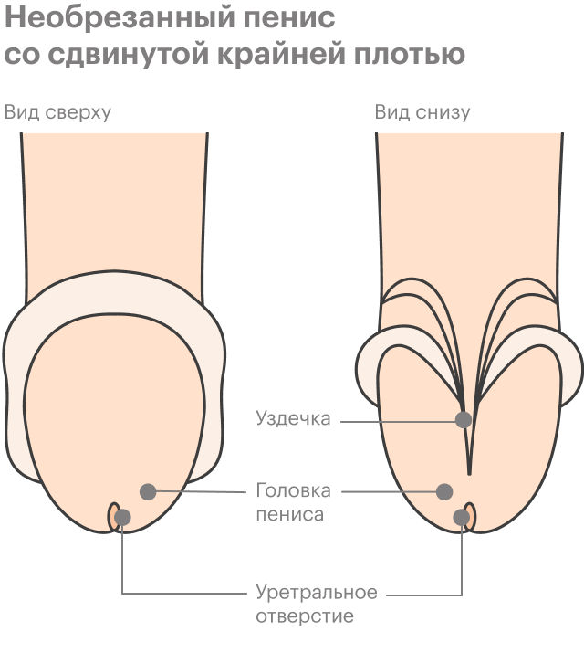 Как Выглядит Обрезание Фото