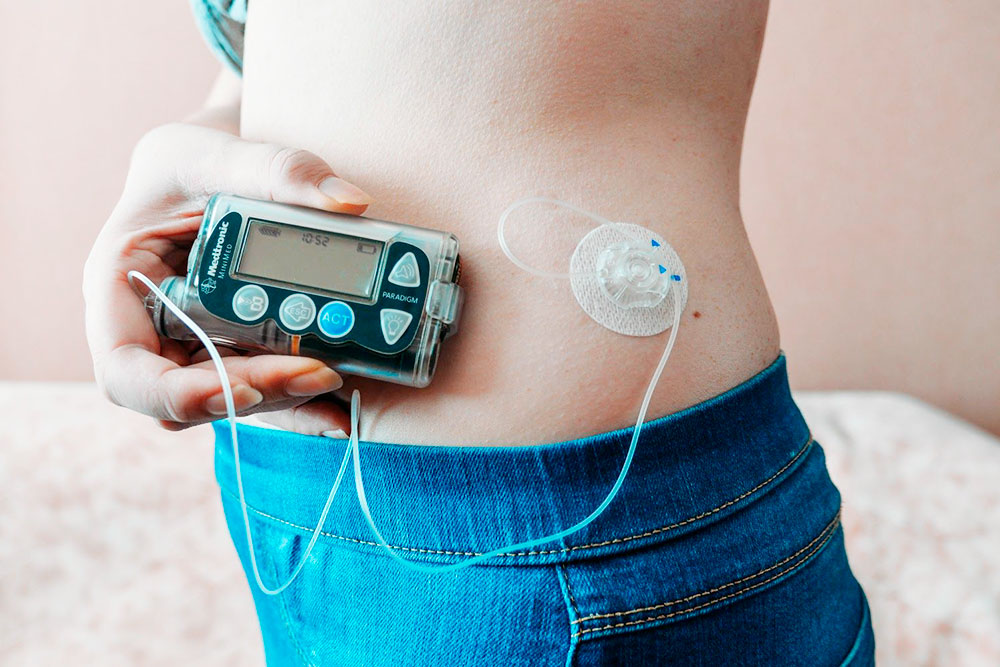 Моя Medtronic MMT-715 — самая простая модель помпы без мониторинга. В 2015 году она стоила около 90 000 <span class=ruble>Р</span>. Сейчас такие сняты с производства, но это не мешает им прекрасно работать