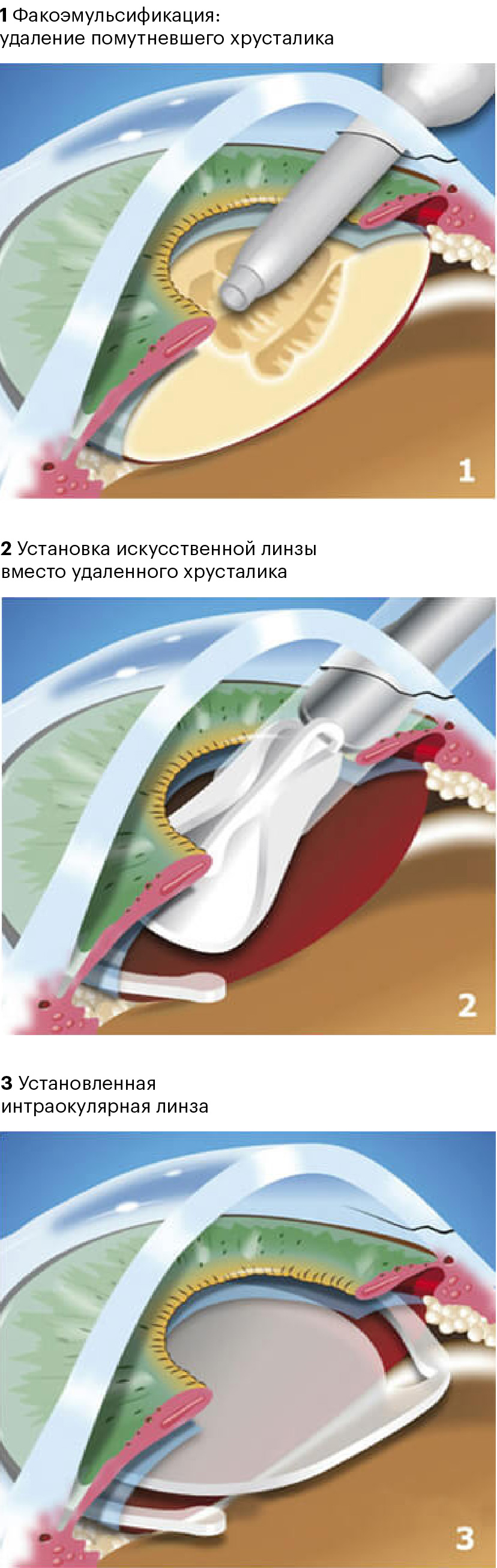 Установка интраокулярной линзы на место помутневшего хрусталика. Источник: iris-center.ru