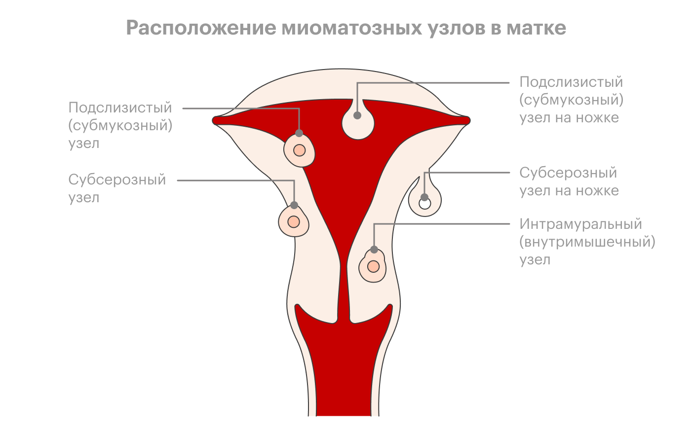 Расположение миоматозных узлов. Локализация миоматозных узлов. Расположение узлов в матке. Субмукозная миома матки.