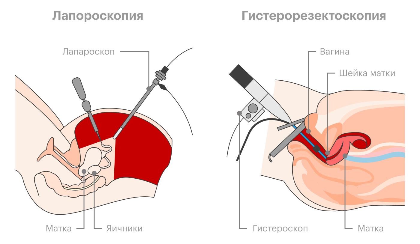 Лапаротомическое удаление миоматозных узлов выглядит как обычная полостная операция с разрезом на животе. При лапароскопической операции хирург вводит гибкие трубки через разрезы на животе, при гистерорезектоскопической — через влагалище, вовсе без разрезов