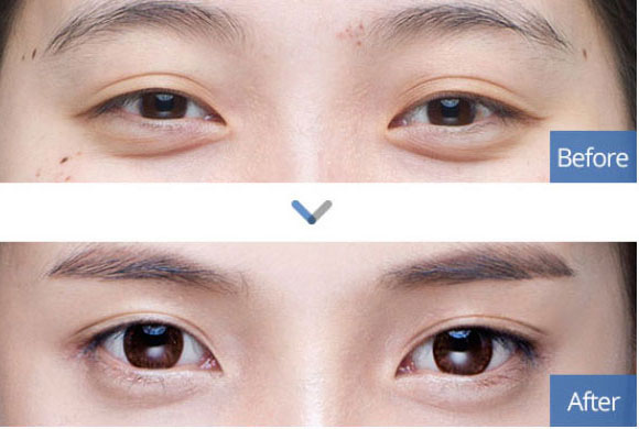 Одна из самых популярных процедур — изменение формы глаз