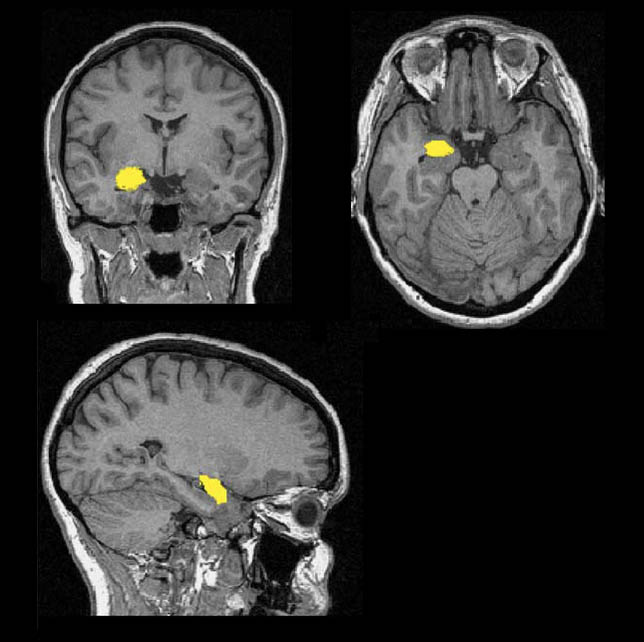 Снимок миндалевидного тела. Источник: Researchgate.net